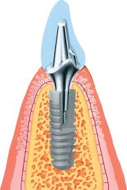Ankylos dental implant diagram