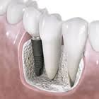 astra tech implant in bone and gum next to natural teeth