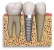 implant between natural teeth