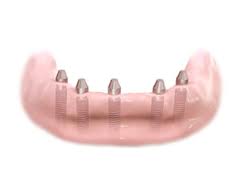 fixed mandible fullarch implant bridge implants placed before bridge placed
